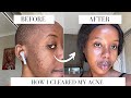 HOW I CLEARED MY ACNE | COMPARING RETIN A, AND HYPODERM (DARK SPOT CORRECTOR) | Namibian YouTuber