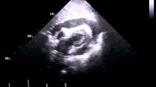 Echocardiogram of a Patient With Cardiac Tamponade