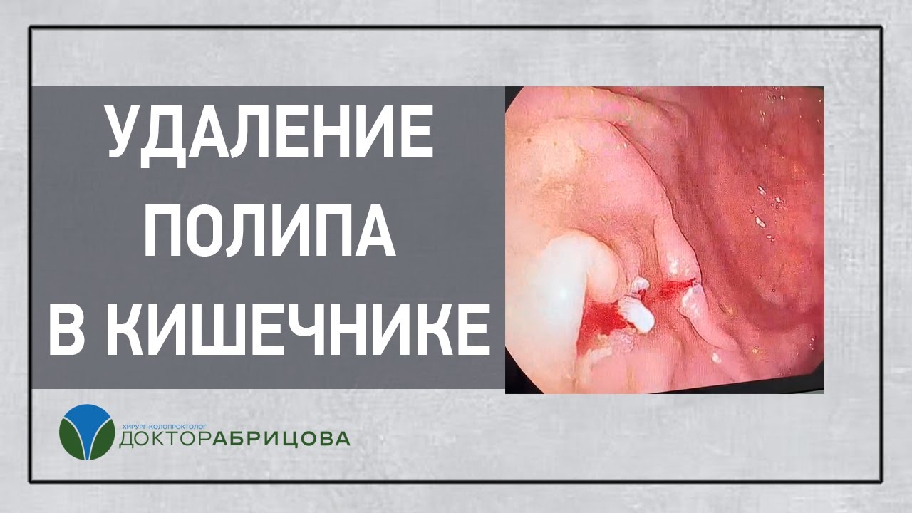 Удаление полипа в кишечнике. Полипэктомия - YouTube