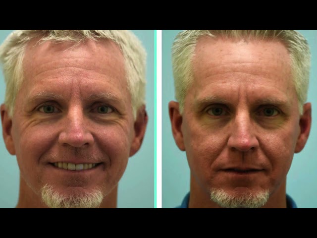 Complex Traumatic Ear Reconstruction Testimonial in Dallas, Texas