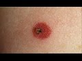 How to Spot Lyme Disease | WebMD