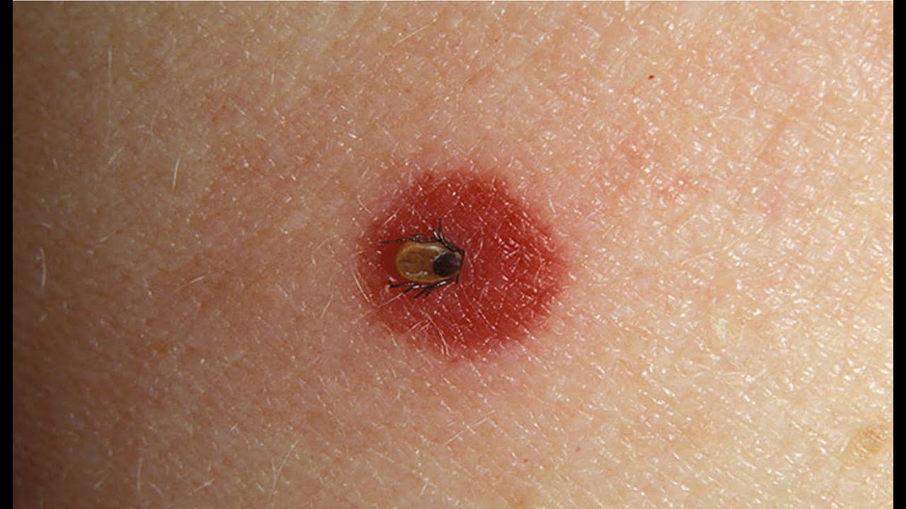 How To Spot Lyme Disease | Webmd
