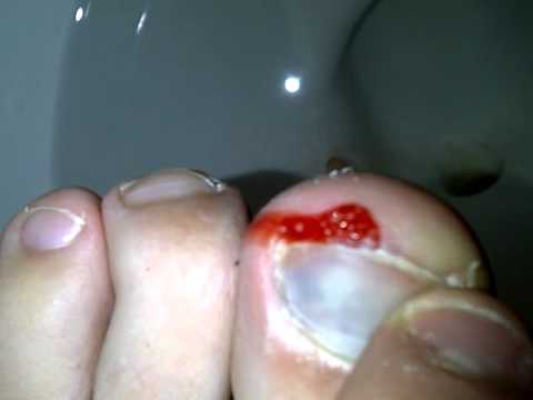 Blood Under Toe Nail You Blood Under Toe Nail