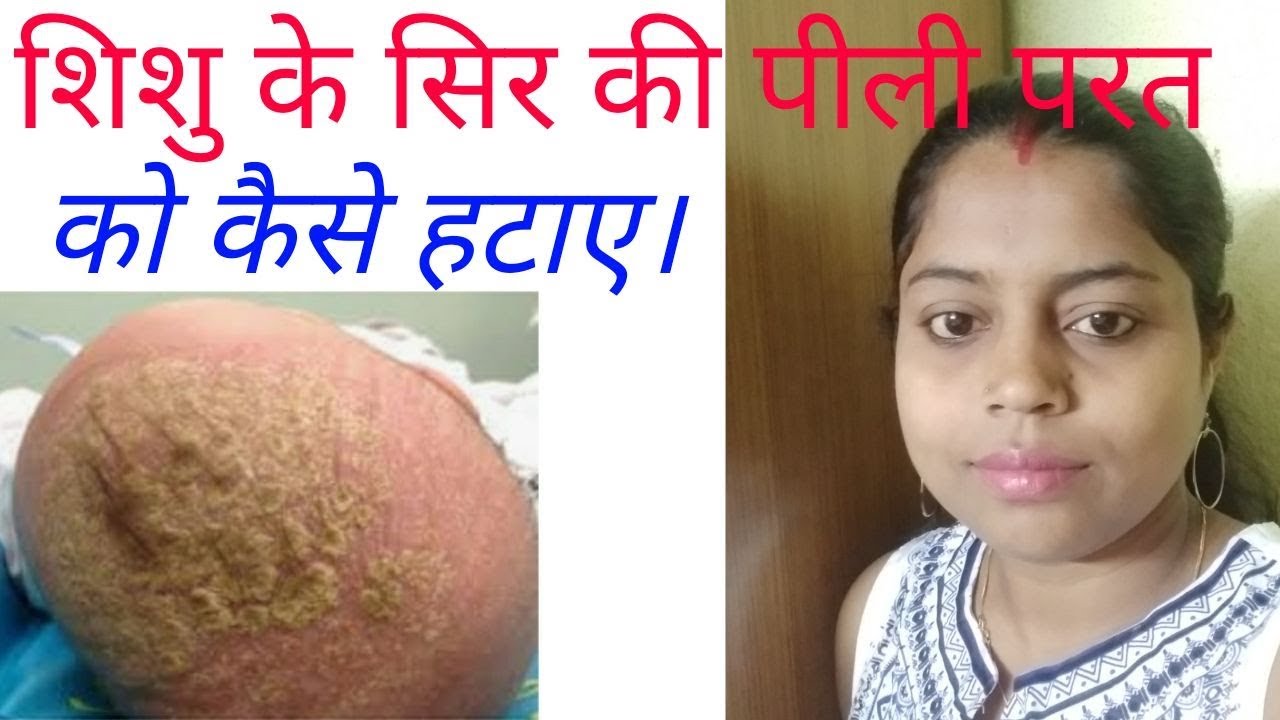 शिशु के सिर की पीली परत को कैसे हटाए।। cradle cap in babies in hindi