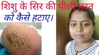 शिशु के सिर की पीली परत को कैसे हटाए।। cradle cap in babies in hindi.