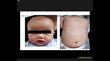 LÂM SÀNG VIÊM DA CƠ ĐỊA