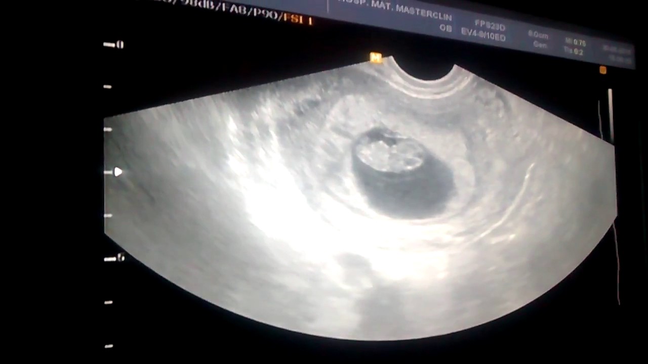 Ultrassom 8 semanas de gravidez e descolamento de placenta YouTube Ultrassom 8 semanas de gravidez e descolamento de placenta YouTube