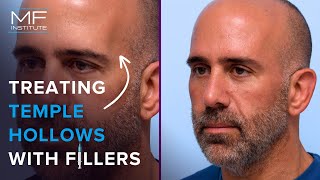 Dermal Fillers For The Temples!? That