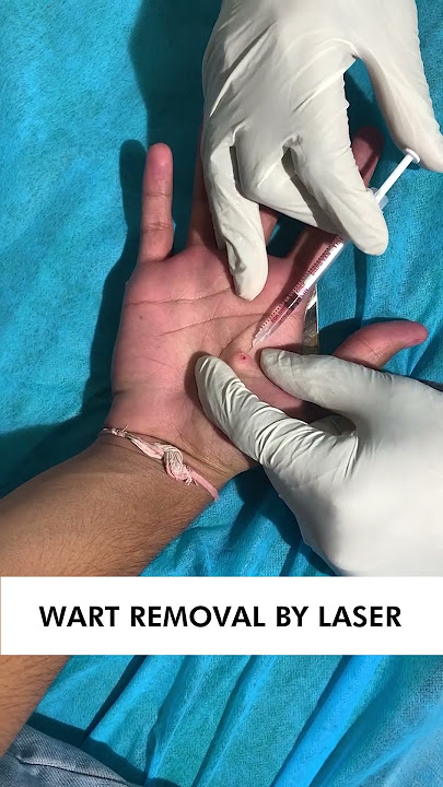Menghilangkan Kutil dengan Perawatan Laser | Perawatan Penghilang Kutil yang Aman dan Efektif | Skinaa Clinic#viral