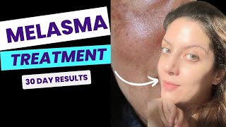 How to remove Melasma at home | Visible results in 30 days | Full AM PM routine to treat Melasma