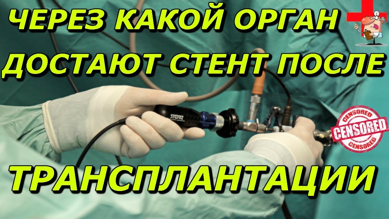 Как удаляют стент после трансплантации почки.