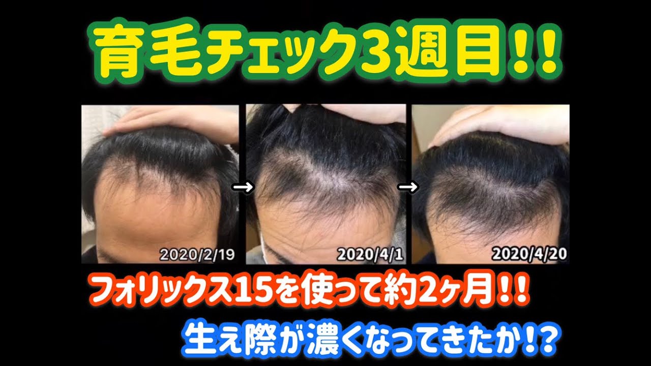 Ep15 育毛チェック3週目 育毛編 Hair Growth Check 3 Weeks Youtube