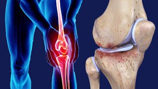 Osteoartritis Tricompartmental: Penyebab Dan Pengobatannya