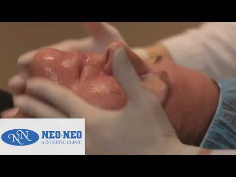კანის ლიფტინგი (გაახალგაზრდავება)/Skin lifting/Neo-neo aesthetic