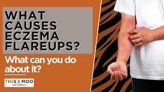What Causes Eczema Flare Ups? What Can You Do About It?