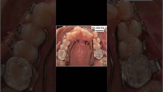 Six Months Result by Quad Helix Appliance @DentCareNepal