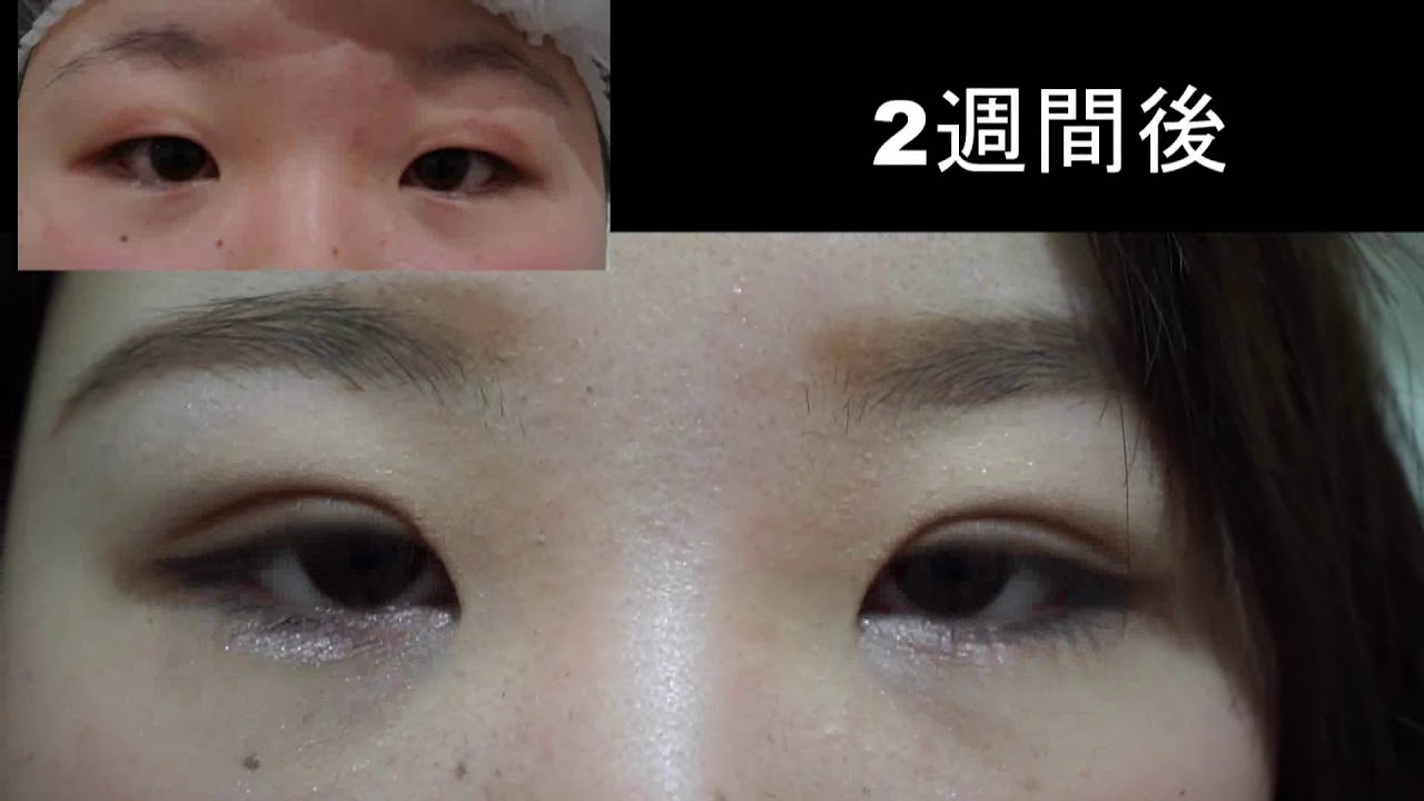 二重整形埋没法 2点止め 一重まぶたから末広型の二重へ Youtube 二重整形埋没法 2点止め 一重まぶたから末広型の二重へ Youtube