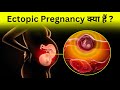 Ectopic pregnanacy    