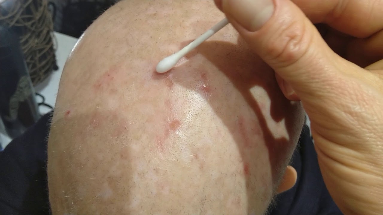 Muscle scar tissue removal surgery