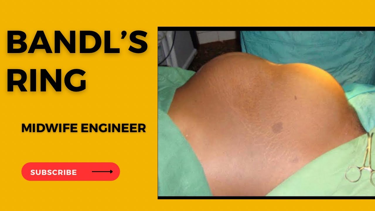 WHAT TO KNOW ABOUT BANDL’S RING Midwife_Engineer YouTube