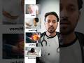 GB stone #doctor #shorts #medico #viral #short #shortsfeed #yt #hospital #explore #shortvideos #yt