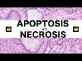 Apoptosis (Intrinsic, Extrinsic Pathways) vs. Necrosis