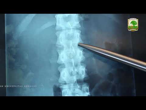 Video: X-Ray Tulang Belakang Lumbosacral: Tujuan, Prosedur, Dan Risiko