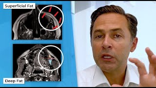 What Happens to Facial Fat Volume as We Age? A Plastic Surgery Discussion by Mohammed S. Alghoul, MD screenshot 4
