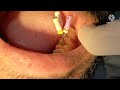 Root canal treatment first molar