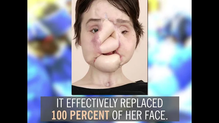 Katie Stubblefield's Face Transplant | By the Numb...