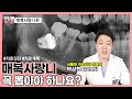 매복사랑니 꼭 뽑아야 하나요?[매복치 진단과 치료방법] | 덴탈메이트