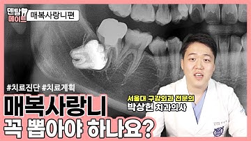 매복사랑니 꼭 뽑아야 하나요?[매복치 진단과 치료방법] | 덴탈메이트