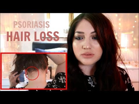 My Hair Loss And Psoriasis Story Youtube