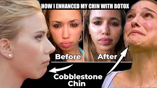 Botox to the Chin Before and Afters | What is Cobblestone chin?