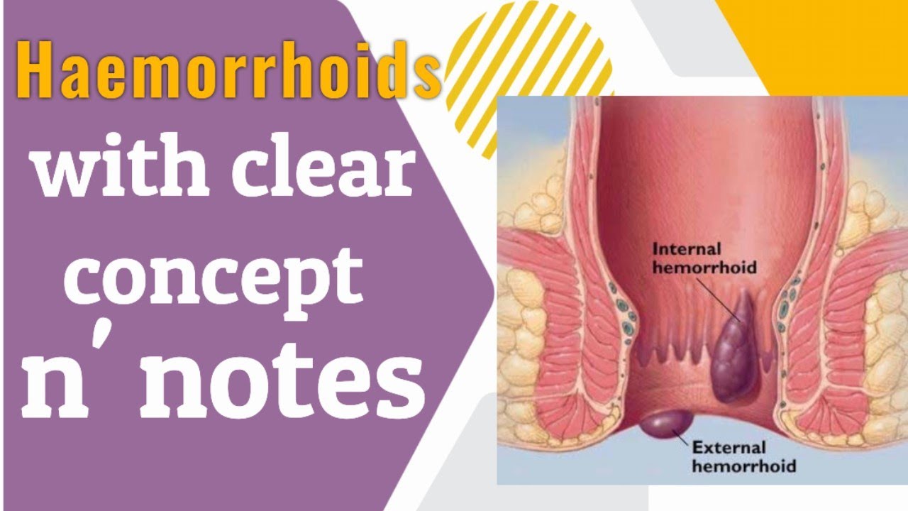Haemorrhoids#ayurveda#shalyatantra#bams4thyr #easygoing#notes