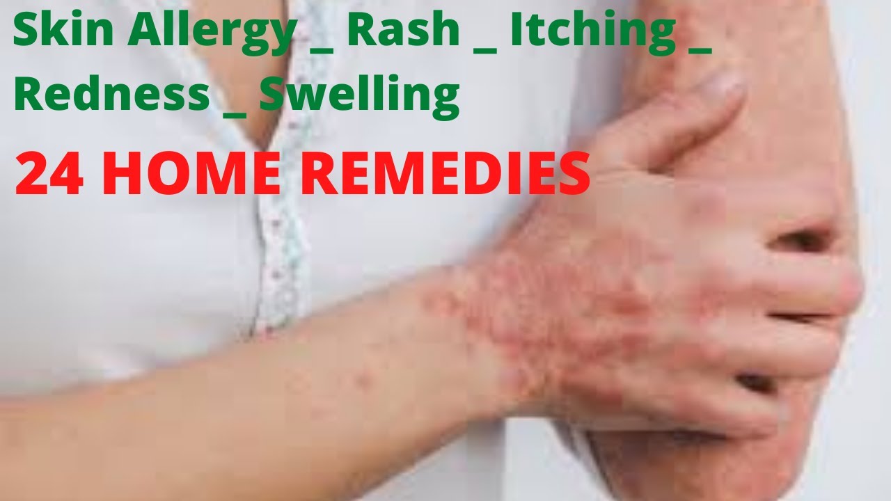 24 Home Remedies to Cure Skin Allergy Rash Itching Redness Swelling