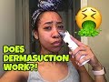 MUST SEE: Dermasuction Review 🤢