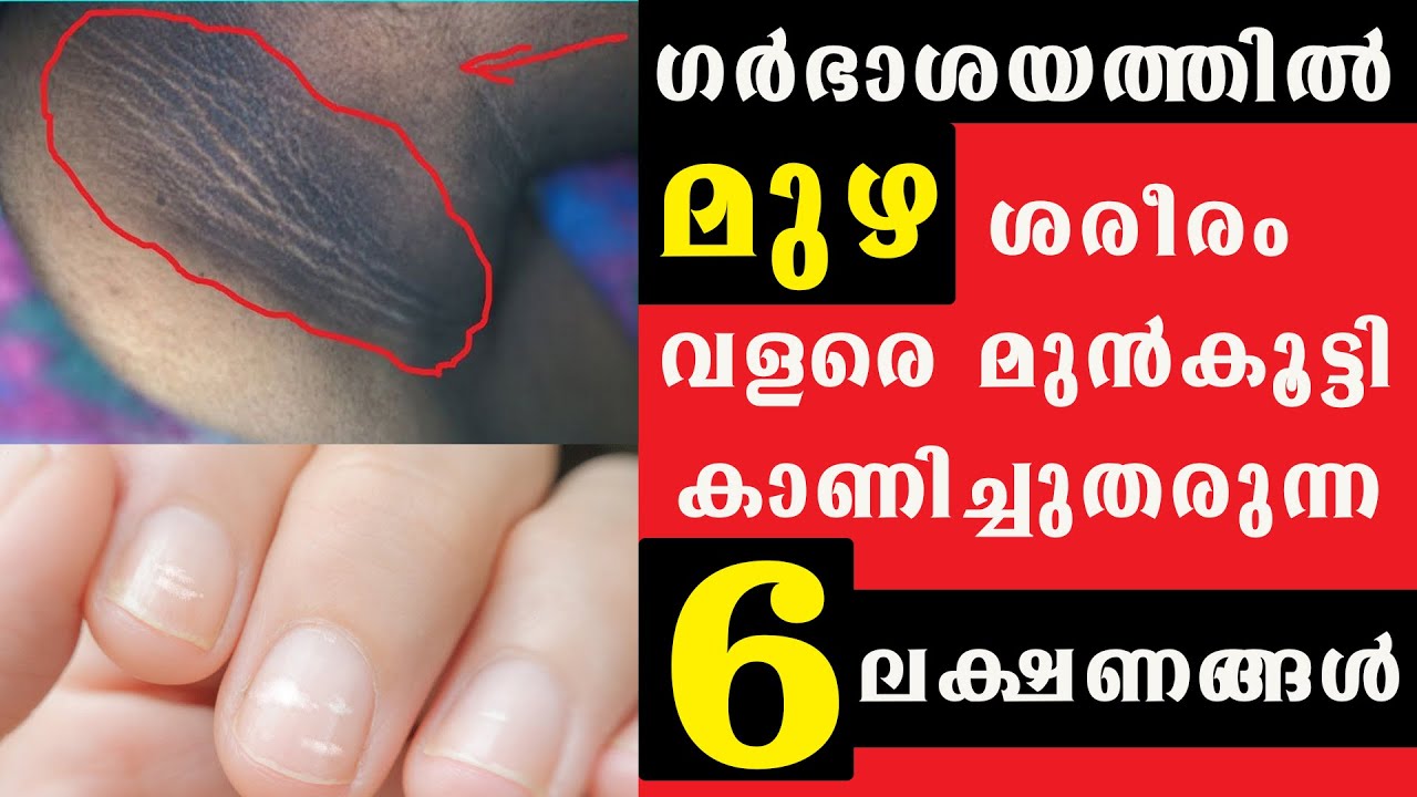 ഗർഭാശയത്തിൽ മുഴ ശരീരം വളരെ മുൻകൂട്ടി കാണിച്ചുതരുന്ന 6 ലക്ഷണങ്ങൾ /Baiju's Vlogs/@BaijusVlogsOfficial