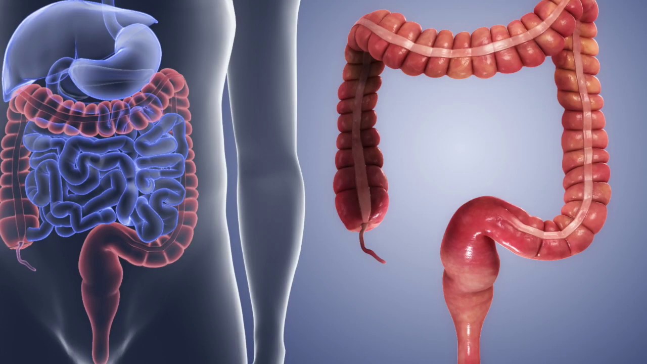 Intestino permeable dieta