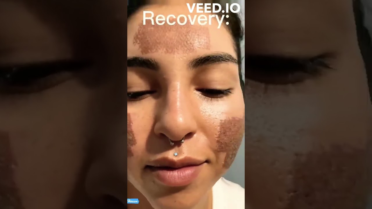 Acne – Dermatologue en téléconsultation