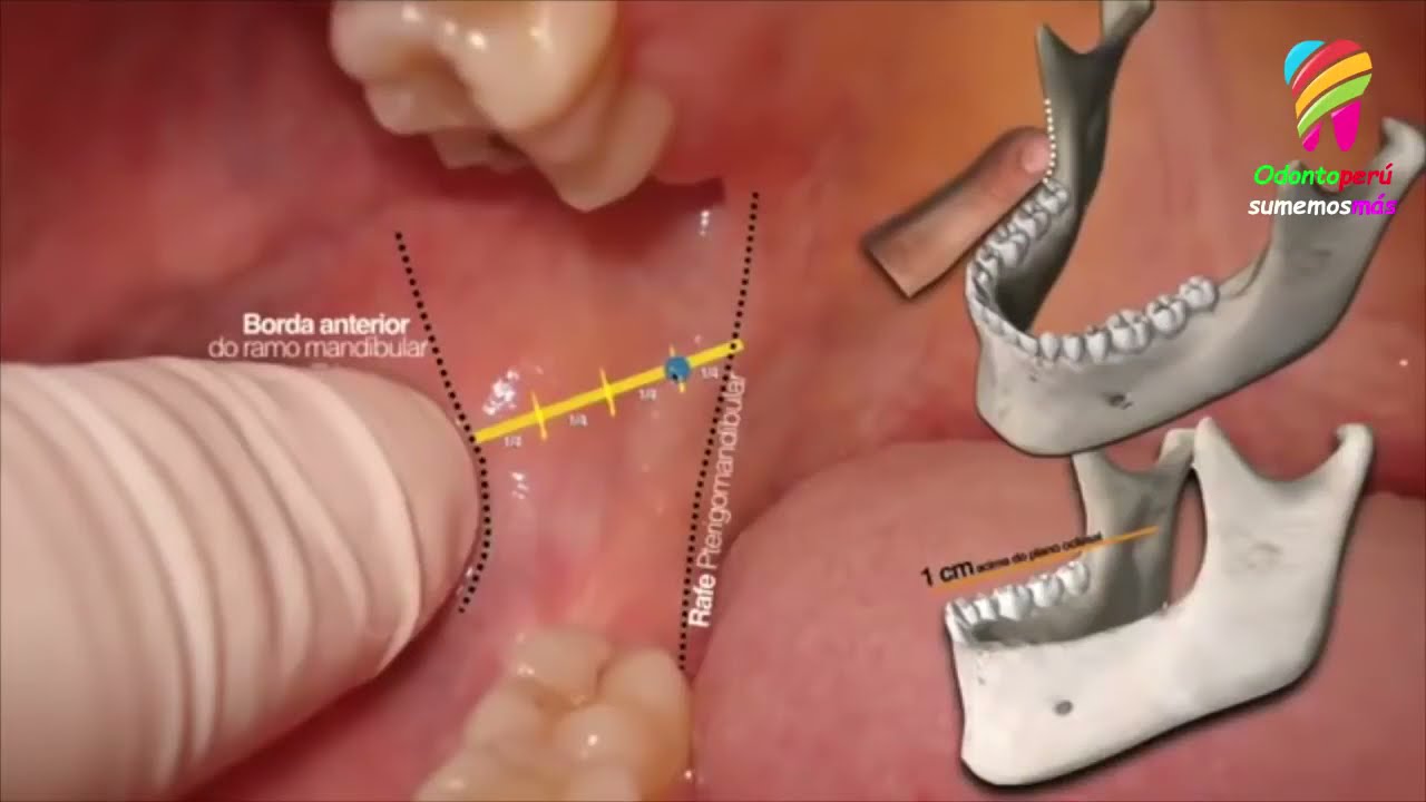 Técnica troncular Bloqueo del nervio dentario inferior y técnica