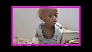 News-Un 400,000 Hungry Yemen Children Face The Risk Of Death