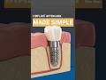 3 Most Important Things After a Dental Implant | Kirkland Dental