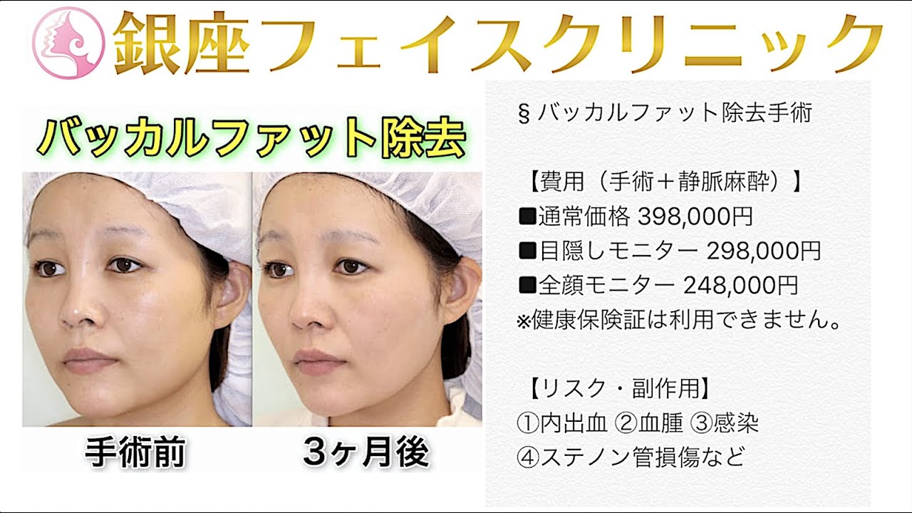 バッカルファット除去の症例写真 No 031 Youtube バッカルファット除去の症例写真 No 031 Youtube