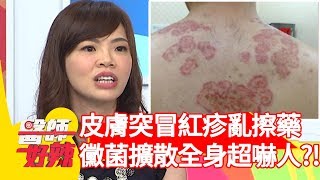 皮膚突冒紅疹亂擦藥黴菌擴散全身超嚇人【醫師好辣】 20190710  part3  EP772 張振榕 翊萱