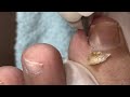 Ep_6325 Ingrown toenail removal 👣 น้องอย่าปล่อยให้เล็บยาว..ตัดแบบนี้ 😄 (clip from Thailand)