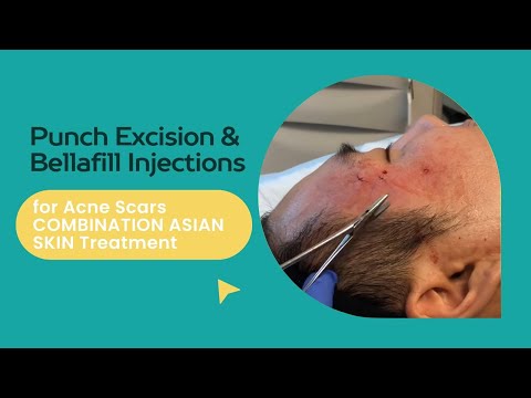 Punch Excision & Bellafill Injections for Acne Scars Treatment | Punch Excision Acne Scars