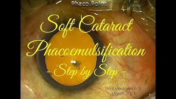 SOFT CATARACT PHACOEMULSIFICATION - STEP BY STEP - A GOOD APPROACH