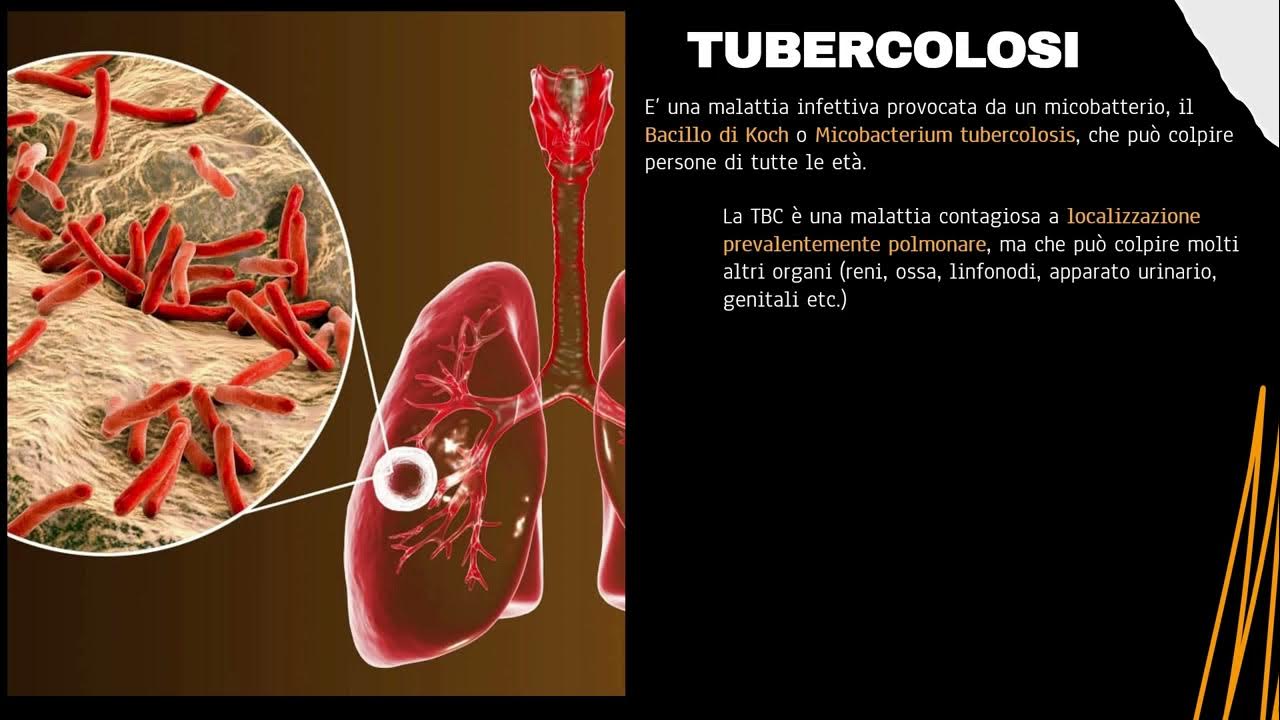 Quante Malattie Si Possono Fare In Un Anno MALATTIE INFETTIVE _ INFLUENZA E TBC - YouTube
