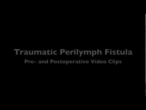 Video: Perilymph Fistula: Symtom, Orsaker, Diagnos Och Behandling